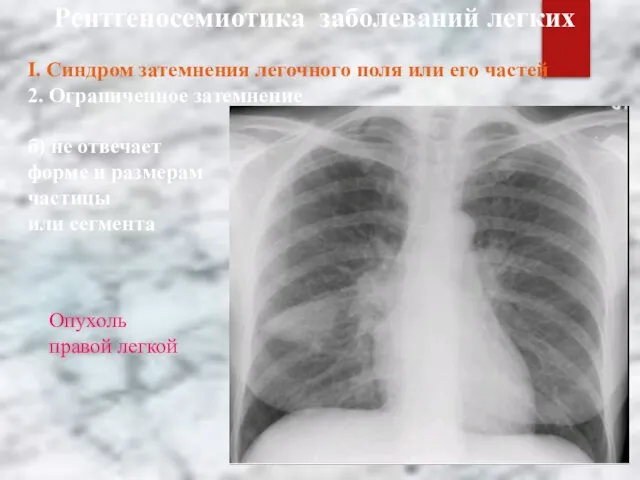 Рентгеносемиотика заболеваний легких