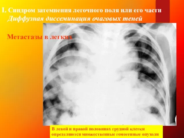 І. Синдром затемнения легочного поля или его части Диффузная диссеминация очаговых