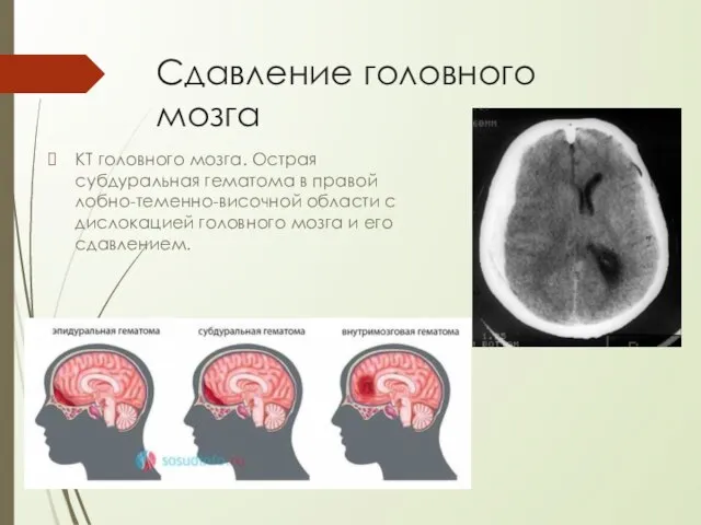 Сдавление головного мозга КТ головного мозга. Острая субдуральная гематома в правой