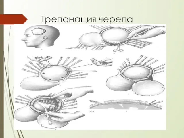 Трепанация черепа