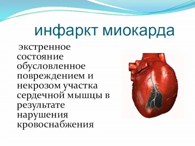 инфаркт миокарда экстренное состояние обусловленное повреждением и некрозом участка сердечной мышцы в результате нарушения кровоснабжения