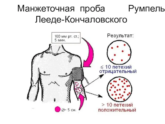 Манжеточная проба Румпель-Лееде-Кончаловского