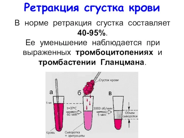 В норме ретракция сгустка составляет 40-95%. Ее уменьшение наблюдается при выраженных