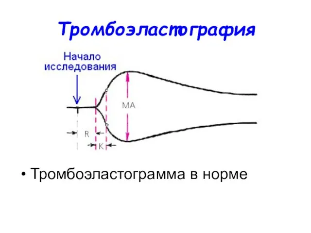 Тромбоэластография Тромбоэластограмма в норме