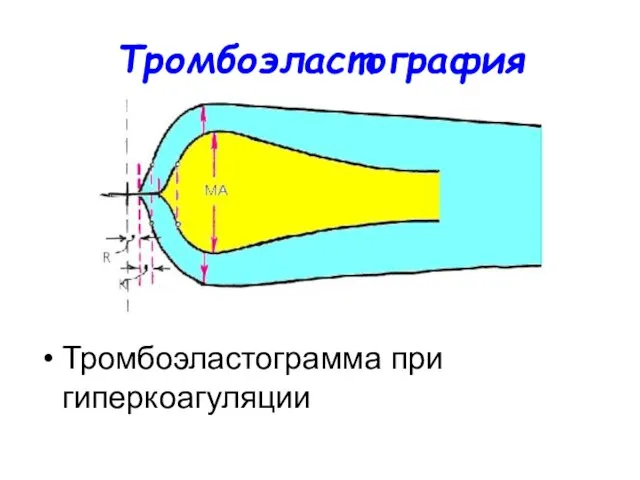 Тромбоэластография Тромбоэластограмма при гиперкоагуляции