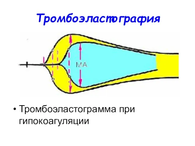 Тромбоэластография Тромбоэластограмма при гипокоагуляции