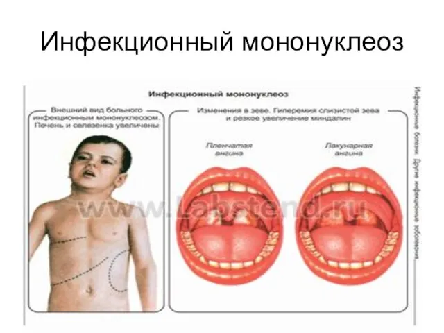 Инфекционный мононуклеоз