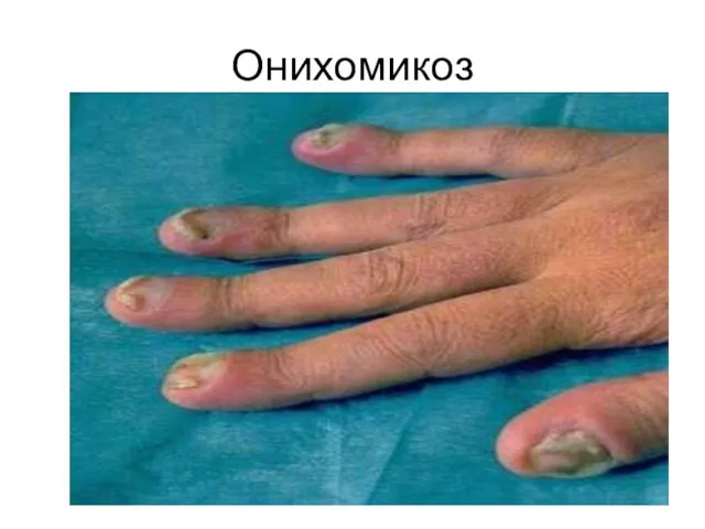 Онихомикоз