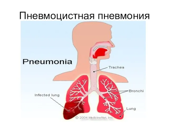 Пневмоцистная пневмония