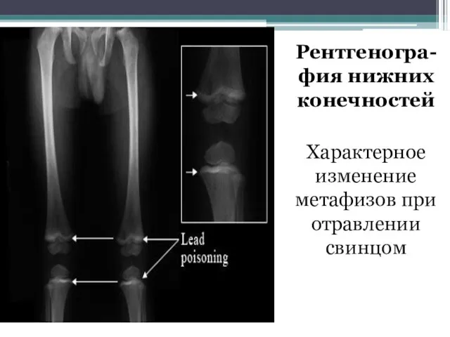 Рентгеногра-фия нижних конечностей Характерное изменение метафизов при отравлении свинцом