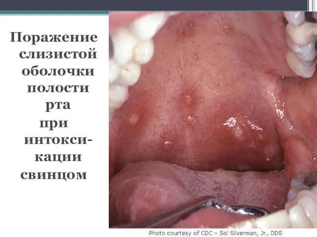 Поражение слизистой оболочки полости рта при интокси-кации свинцом