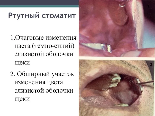 Ртутный стоматит 1.Очаговые изменения цвета (темно-синий) слизистой оболочки щеки 2. Обширный