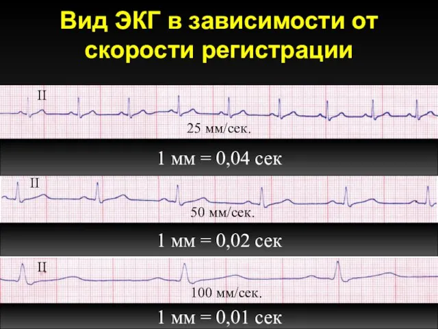 Вид ЭКГ в зависимости от скорости регистрации 25 мм/cек. 50 мм/cек.