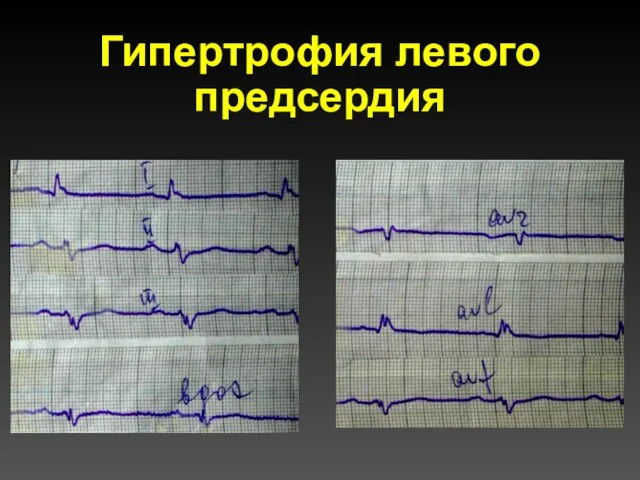 Гипертрофия левого предсердия