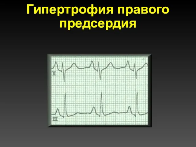 Гипертрофия правого предсердия