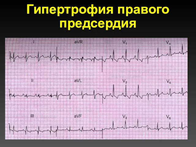 Гипертрофия правого предсердия