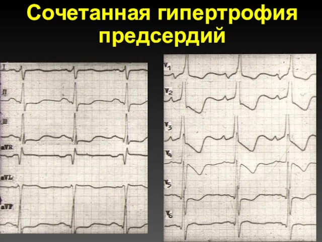 Сочетанная гипертрофия предсердий