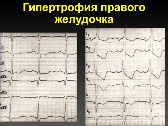 Гипертрофия правого желудочка
