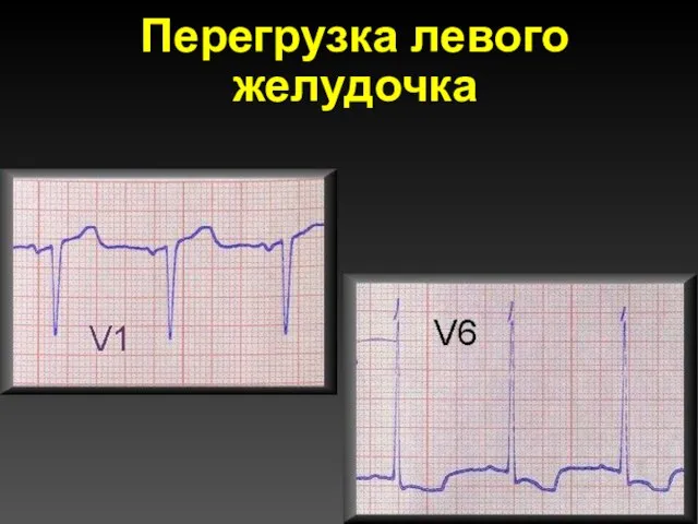 Перегрузка левого желудочка