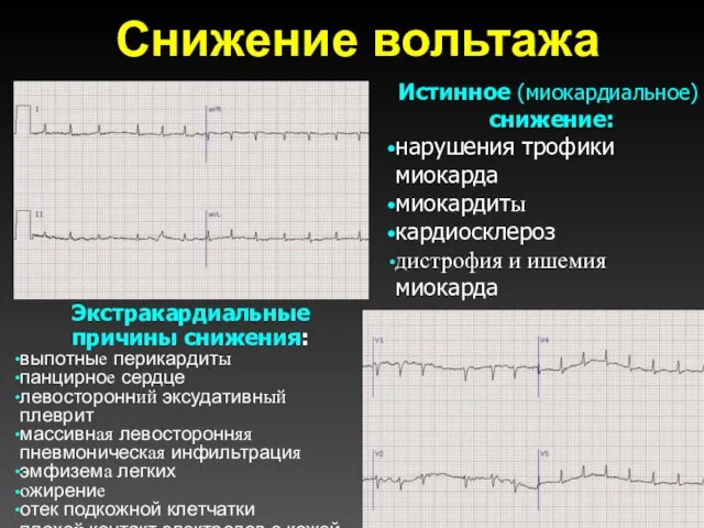 Снижение вольтажа Истинное (миокардиальное) снижение: нарушения трофики миокарда миокардиты кардиосклероз дистрофия