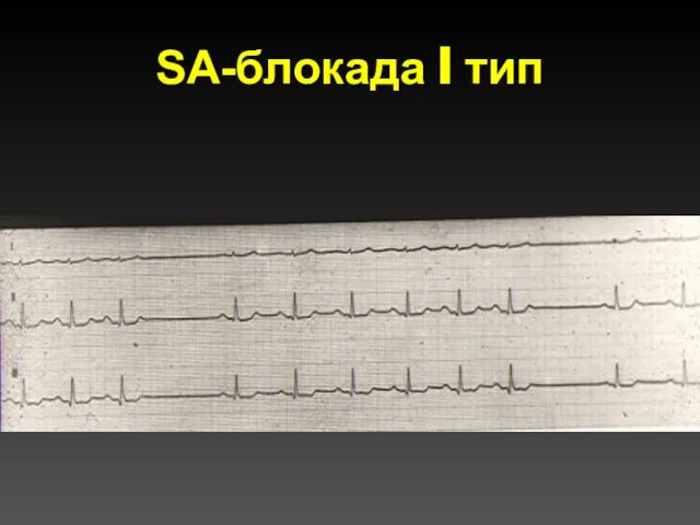 SА-блокада I тип