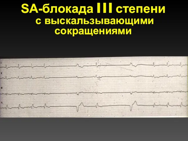 SА-блокада I I I степени с выскальзывающими сокращениями