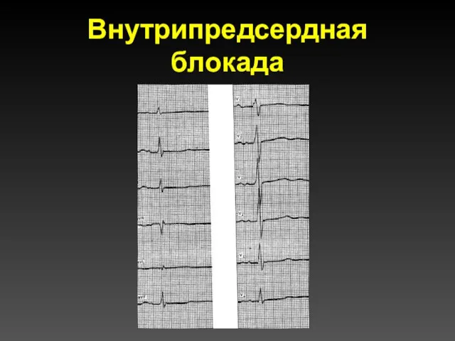 Внутрипредсердная блокада