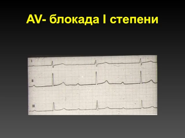 AV- блокада I степени