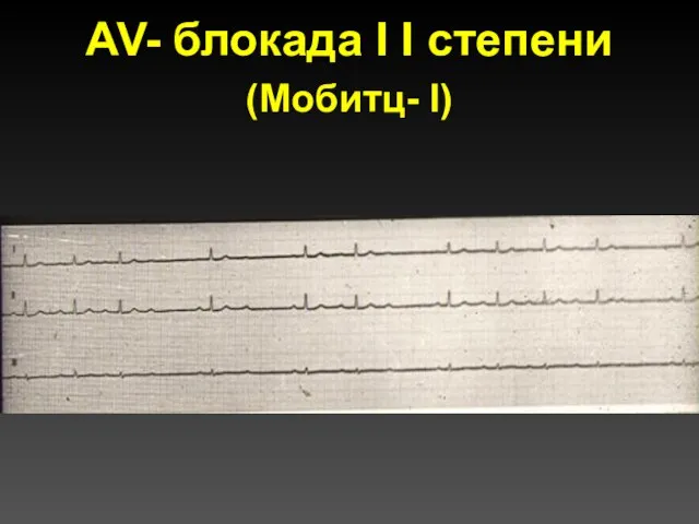 AV- блокада I I степени (Мобитц- I)