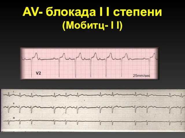 AV- блокада I I степени (Мобитц- I I)