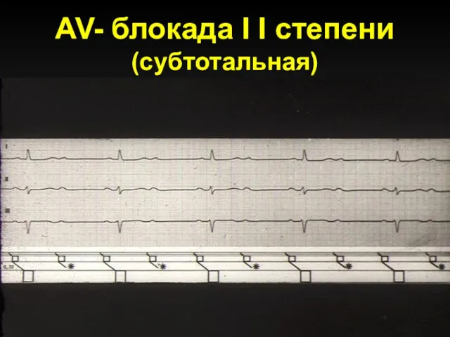 AV- блокада I I степени (субтотальная)