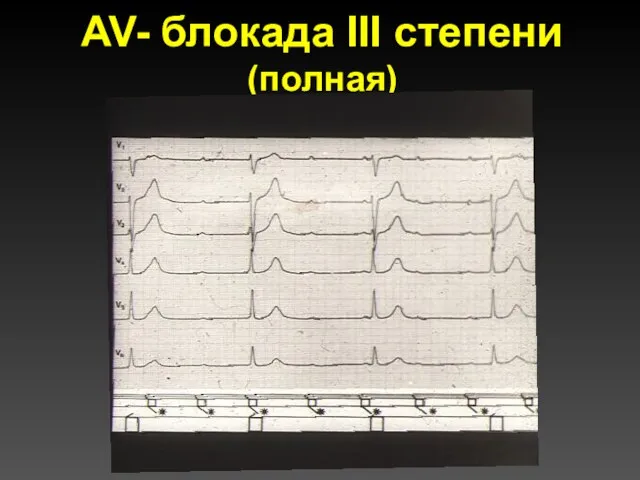 AV- блокада III степени (полная)