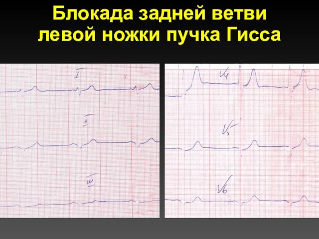 Блокада задней ветви левой ножки пучка Гисса