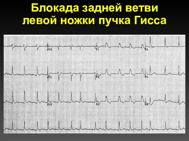 Блокада задней ветви левой ножки пучка Гисса