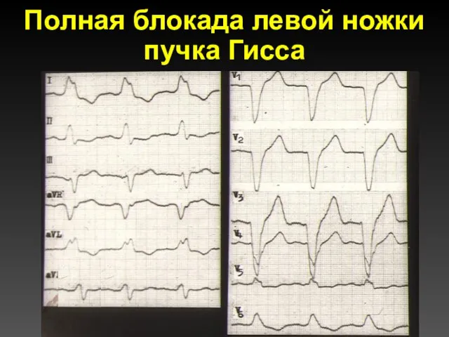 Полная блокада левой ножки пучка Гисса