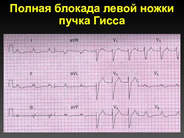 Полная блокада левой ножки пучка Гисса