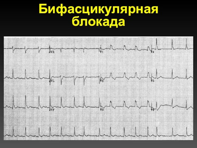 Бифасцикулярная блокада