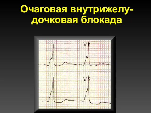 Очаговая внутрижелу-дочковая блокада