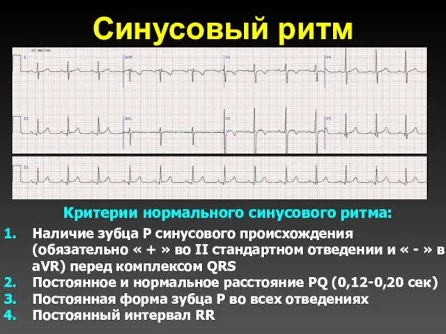 Синусовый ритм I II Критерии нормального синусового ритма: Наличие зубца Р