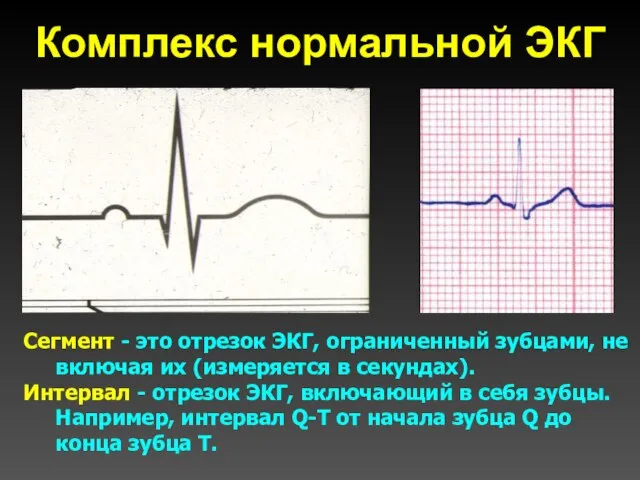 Комплекс нормальной ЭКГ Сегмент - это отрезок ЭКГ, ограниченный зубцами, не