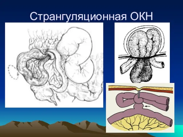 Странгуляционная ОКН