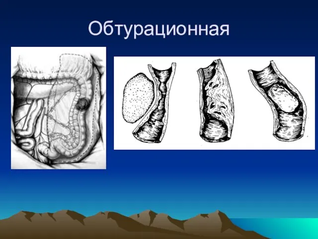 Обтурационная