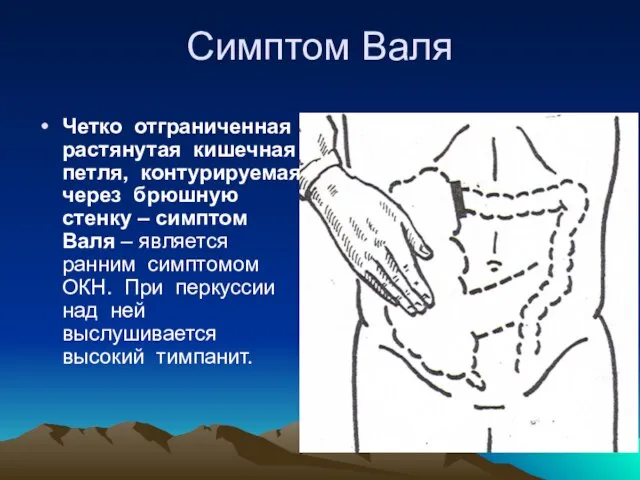 Симптом Валя Четко отграниченная растянутая кишечная петля, контурируемая через брюшную стенку