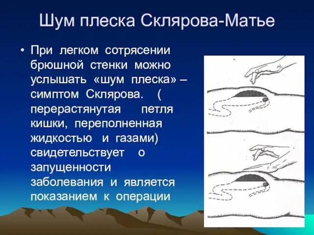 Шум плеска Склярова-Матье При легком сотрясении брюшной стенки можно услышать «шум