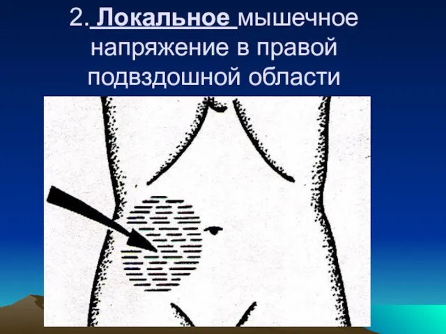 2. Локальное мышечное напряжение в правой подвздошной области