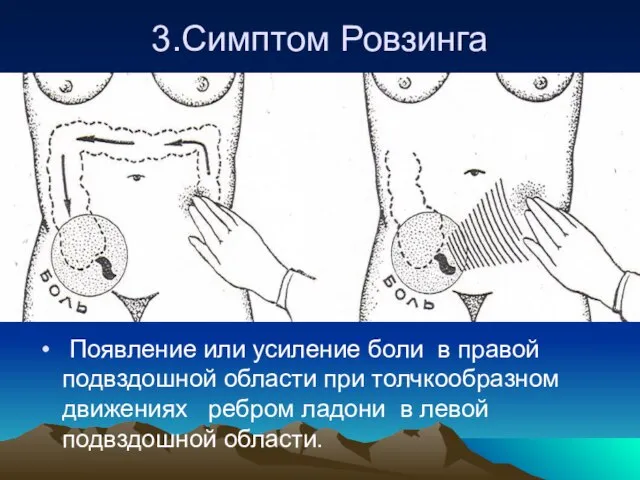 3.Симптом Ровзинга Появление или усиление боли в правой подвздошной области при