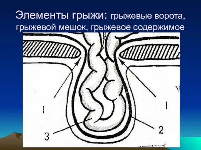 Элементы грыжи: грыжевые ворота, грыжевой мешок, грыжевое содержимое