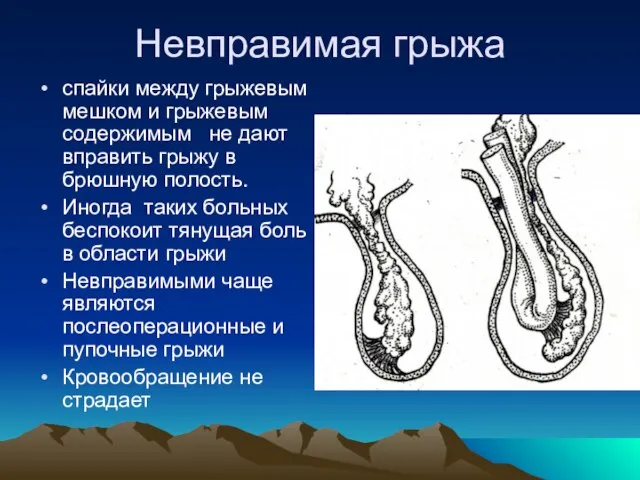 Невправимая грыжа спайки между грыжевым мешком и грыжевым содержимым не дают