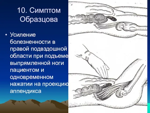 10. Симптом Образцова Усиление болезненности в правой подвздошной области при подъеме