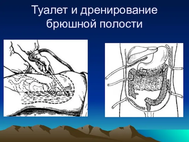 Туалет и дренирование брюшной полости